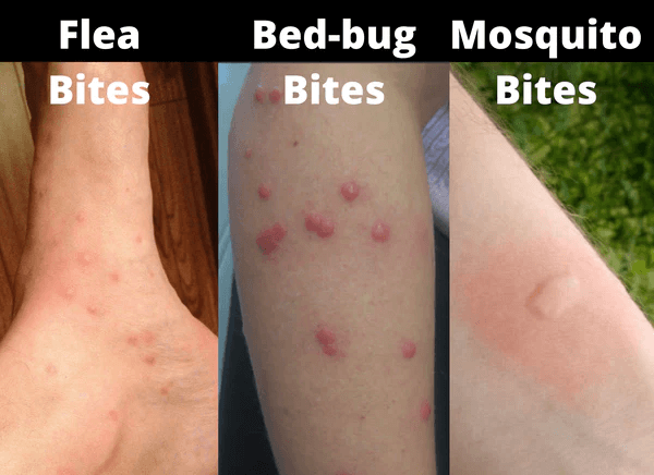 fleas and bed bugs bites